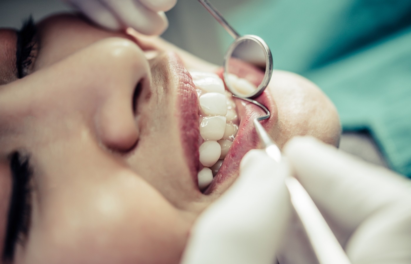 کمبود این ویتامین ها خطر پوسیدگی دندان را افزایش می دهد