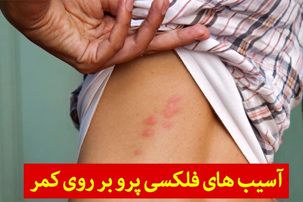 آسیب فلکسی پرو بر روی