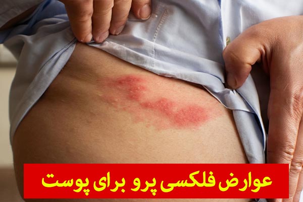 عوارض فلکسی پرو بر روی