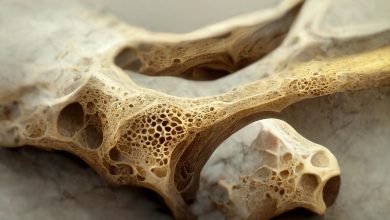 علت عمده ایجاد پوکی استخوان چیست؟