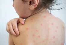 سرخک دوباره