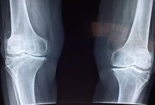 تشخیص پوکی استخوان هوش مصنوعی