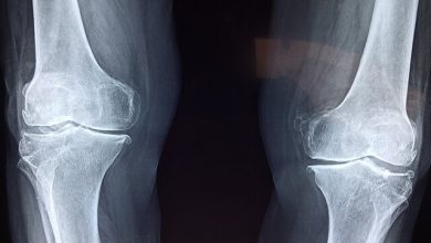 تشخیص پوکی استخوان هوش مصنوعی