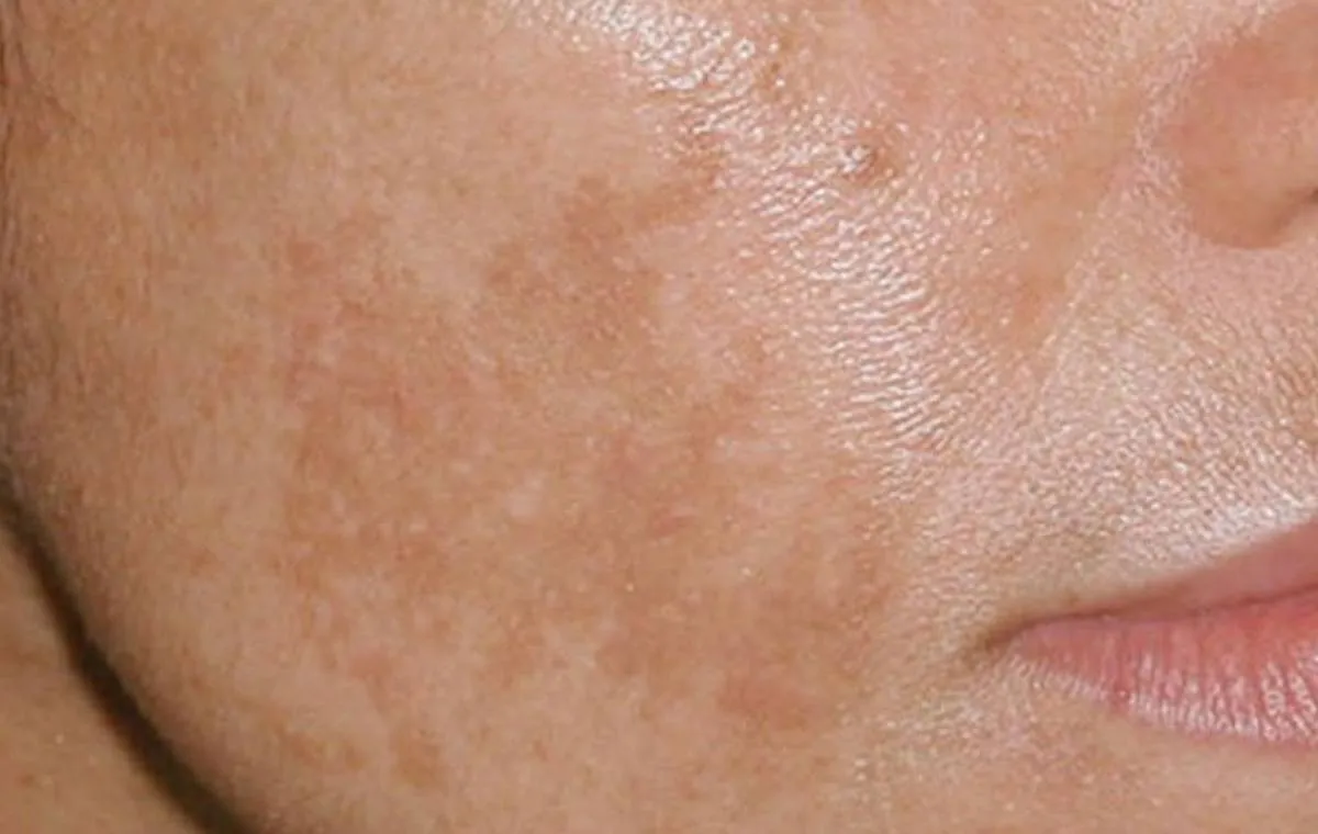 لک‌های پوستی