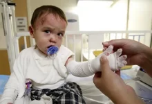 بیماری ای بی