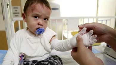 بیماری ای بی