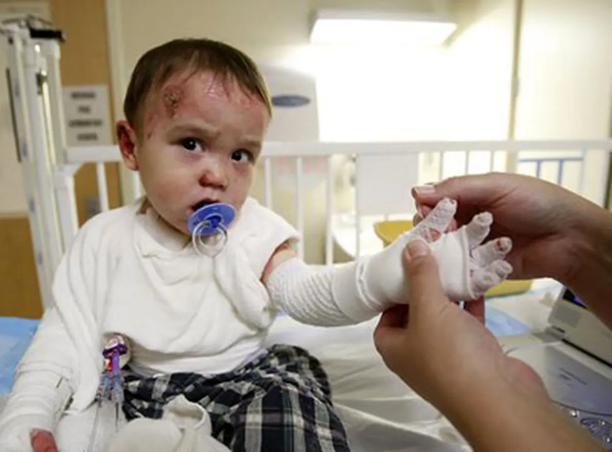 بیماری ای بی