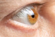 شیوع قوز قرنیه در ایران بالاتر از میانگین جهانی