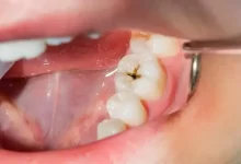 خطر سکته مغزی