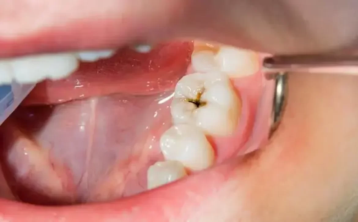 خطر سکته مغزی