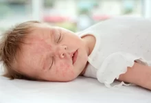 «حساسیت غذایی» در کودکان