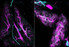 سرطان لوزالمعده