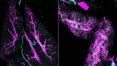 سرطان لوزالمعده