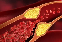 داروی جدید برای کاهش کلسترول خون و ریسک سکته قلبی