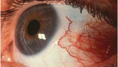 اقدامات اولیه و اورژانسی آسیب‌های چشمی