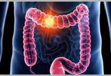 علت شیوع ۱۱ نوع سرطان در جوانان انگلیسی