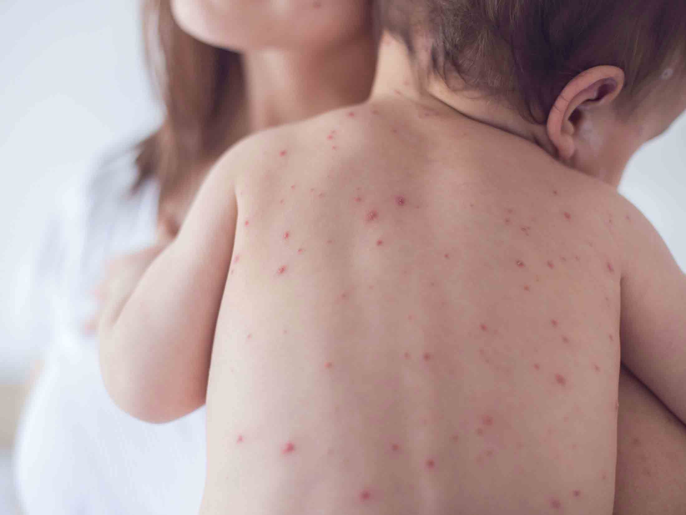 آنچه والدین باید درباره آبله‌مرغان و زونا بدانند