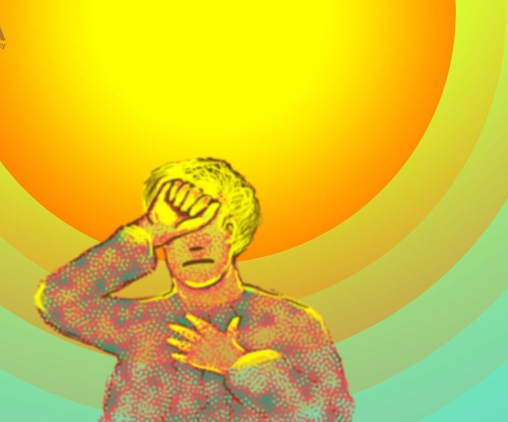 آفتاب‌سوختگی
