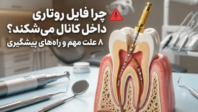 علل شکستن فایل اندو و تجهیزات عصب کشی در دندانپزشکی