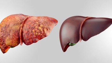 شایع‌ترین بیماری کبدی جهان چیست؟